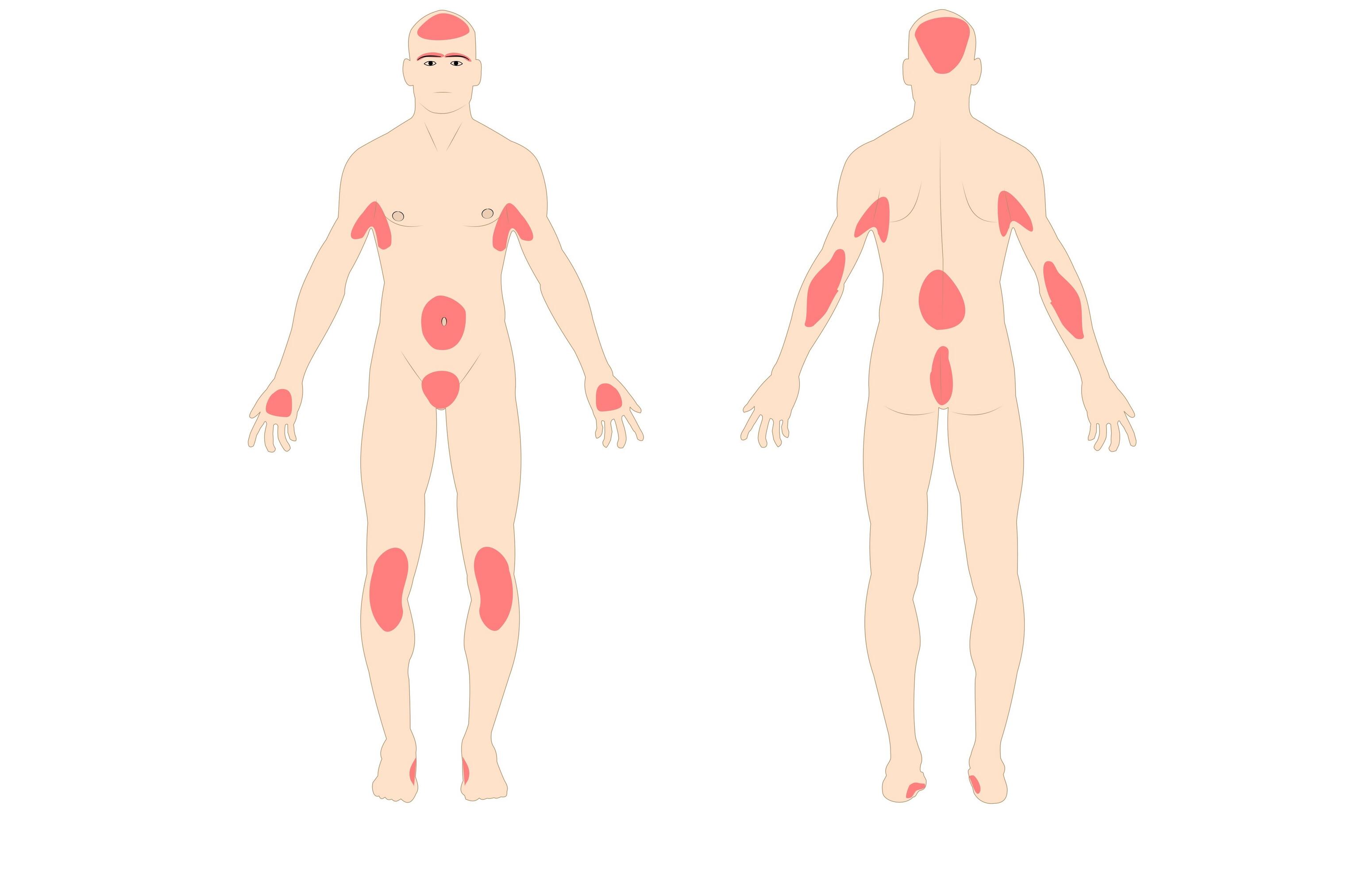 Síntomas y diagnóstico de la dermatitis seborreica del cuero cabelludo